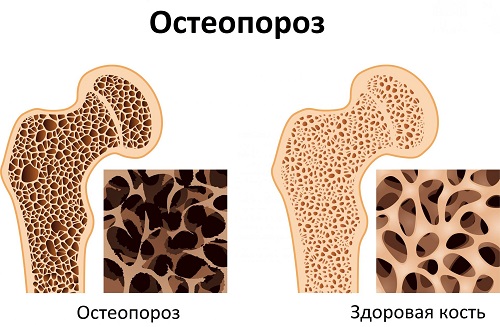 Остеопороз у женщин: симптомы, профилактика и лечение