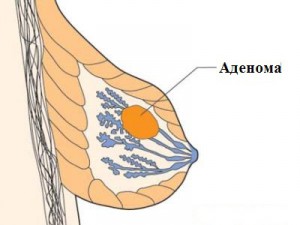 Аденома молочной железы: симптомы, диагностика и лечение