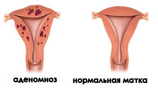 Аденомиоз матки – что это такое? Симптомы, причины и лечение