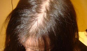 Выпадение волос: причины и лечение у женщин