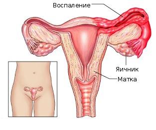Воспаление придатков у женщин – симптомы и схема лечения
