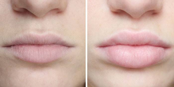 Гиалуроновая кислота в губы - плюсы и минусы