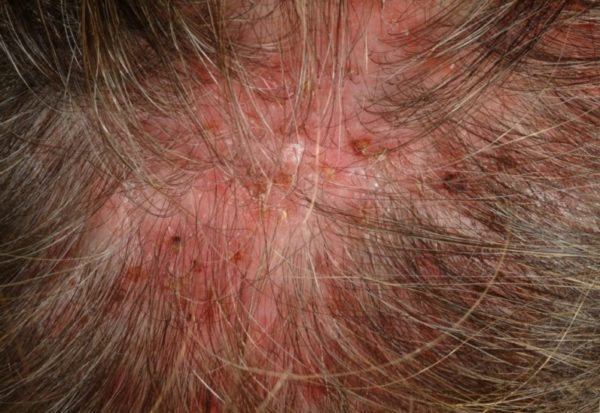 Лечение заболеваний волос и кожи головы