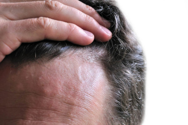 Лечение заболеваний волос и кожи головы