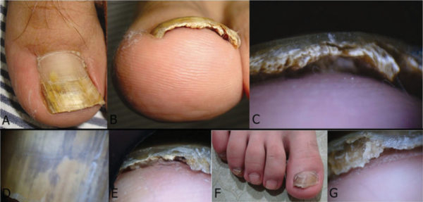 Быстрое и эффективное лечение грибка ногтей