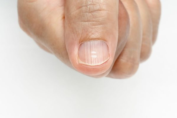 Диагностика состояния здоровья по внешнему виду ногтей