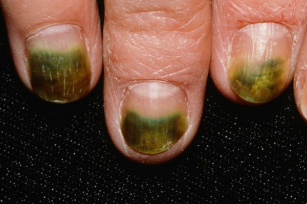 Диагностика состояния здоровья по внешнему виду ногтей