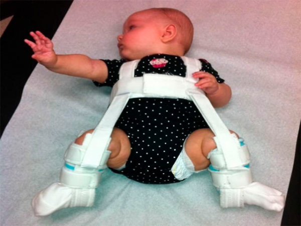 Дисплазия тазобедренных суставов у новорожденных как диагностировать и выделить заболевание?