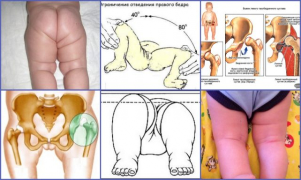 Дисплазия тазобедренных суставов у новорожденных как диагностировать и выделить заболевание?